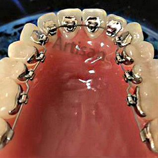 <strong>牙齒（chǐ）矯正精密零部件加工,,</strong>